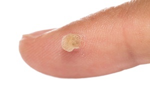 En vårta är en hudsjukdom som effektivt bekämpar Skincell Pro